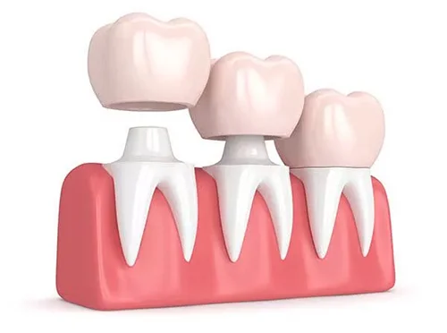 3D illustration of tooth model showing dental crowns being placed over prepared teeth with pink gum base representing dental crowns Astoria treatment and restoration.