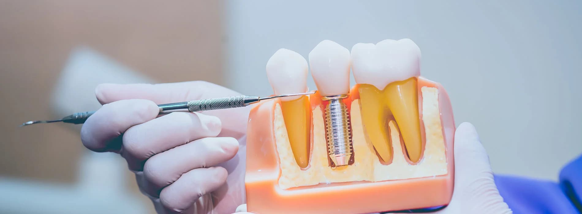 Photo of astoria dental implants model held by gloved hands with a dental tool