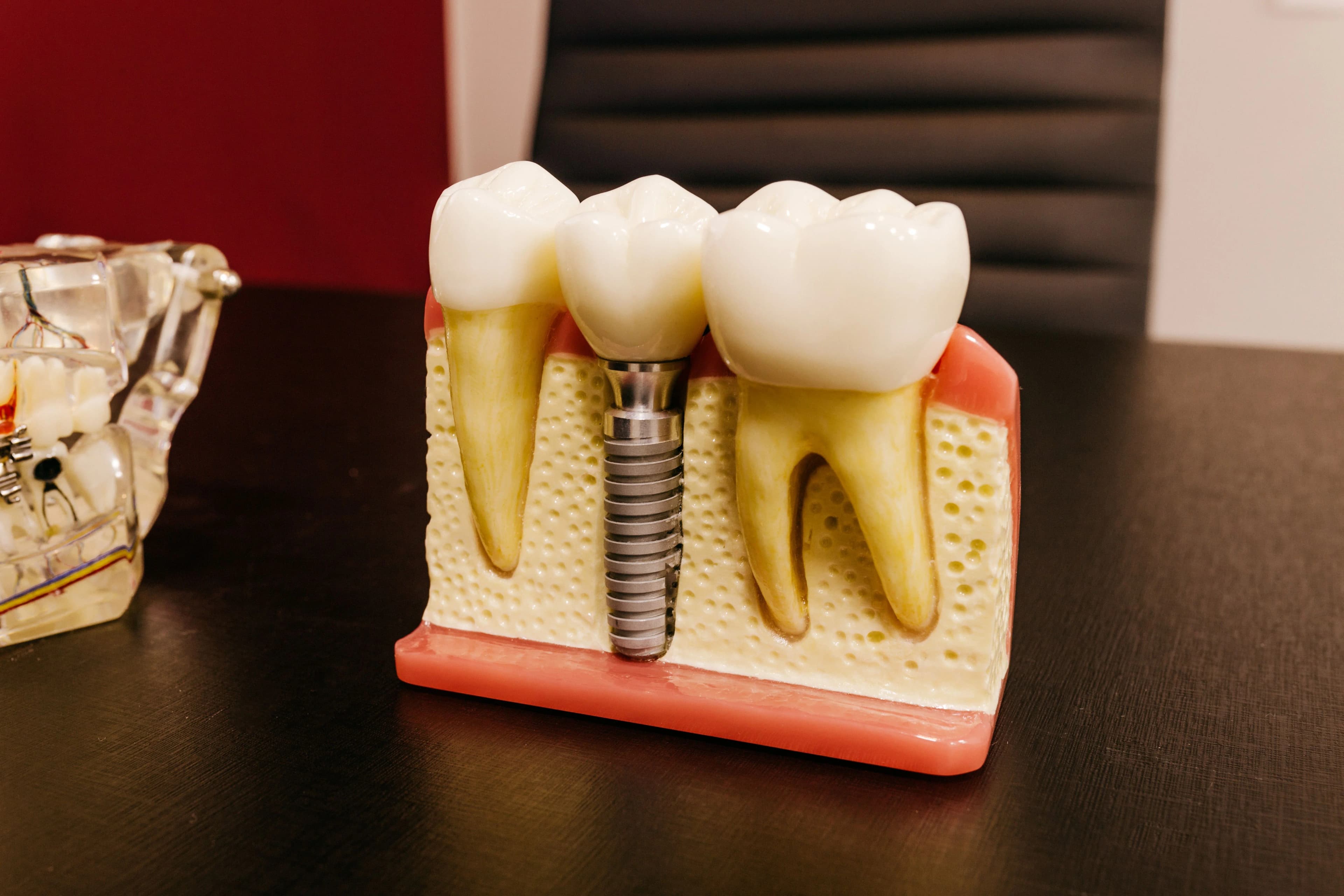 Photo of astoria dental implants model showing an implant between natural teeth