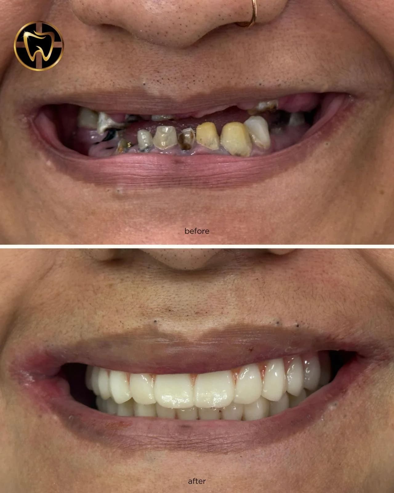 Photo of before and after smile showing damaged teeth restored with full white teeth