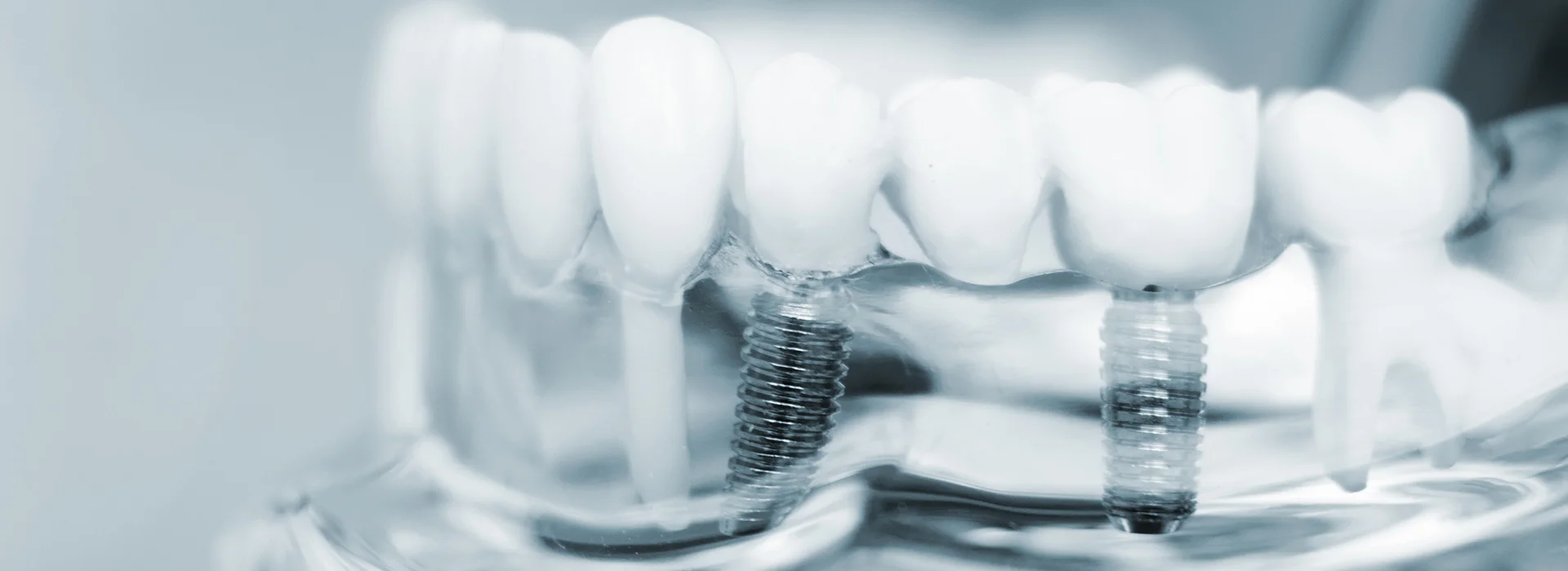 Close up of a transparent dental model showing artificial teeth attached to metal implants inside a clear jaw demonstrating how dental implants are secured and integrated within the bone for tooth replacement.