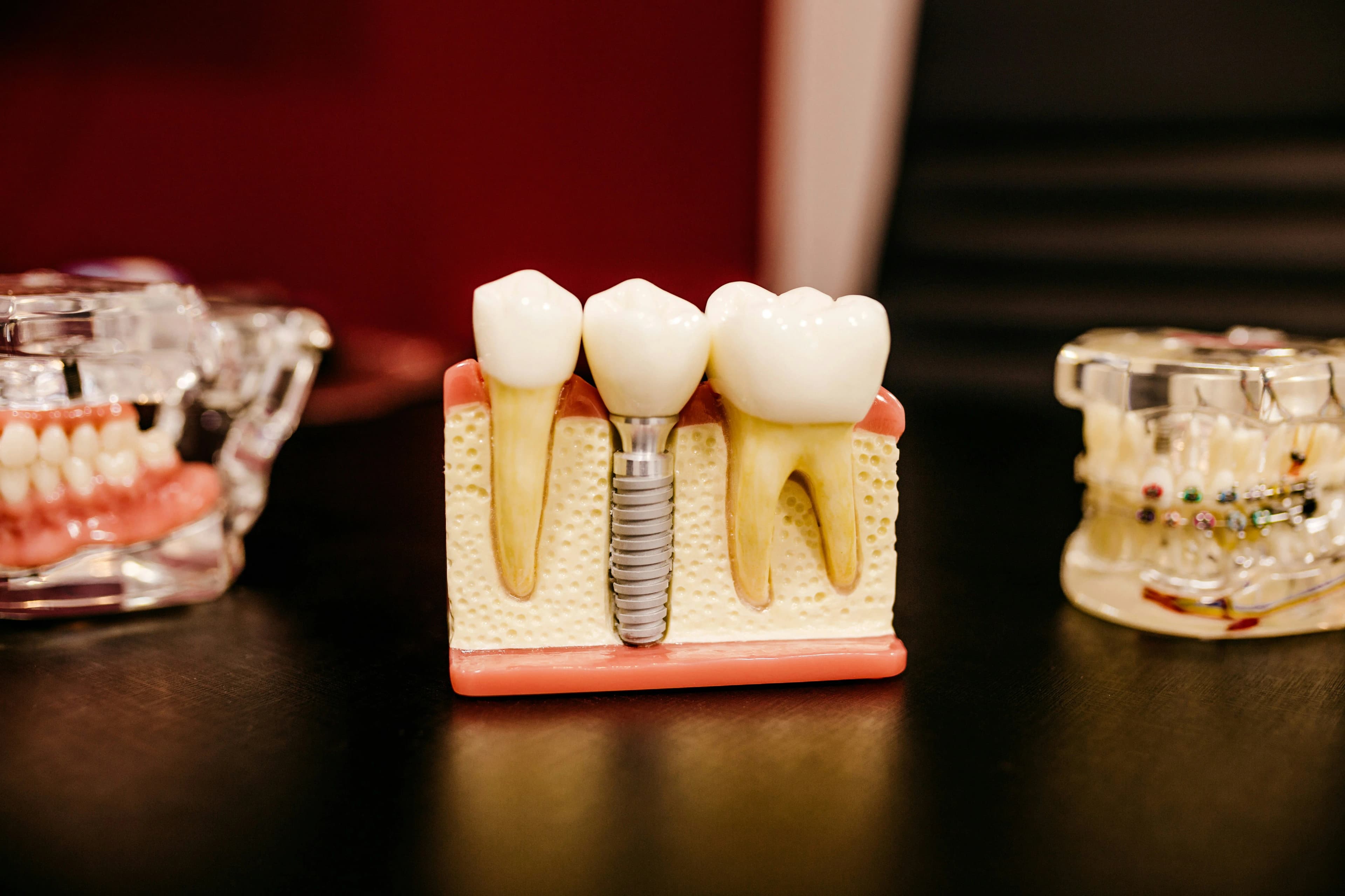 What Are All on Four Dental Implants?