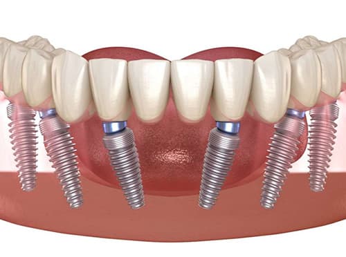 illustration-full-arch-dental-implants-with-six-titanium-posts-supporting-upper-replacement-teeth-and-gums